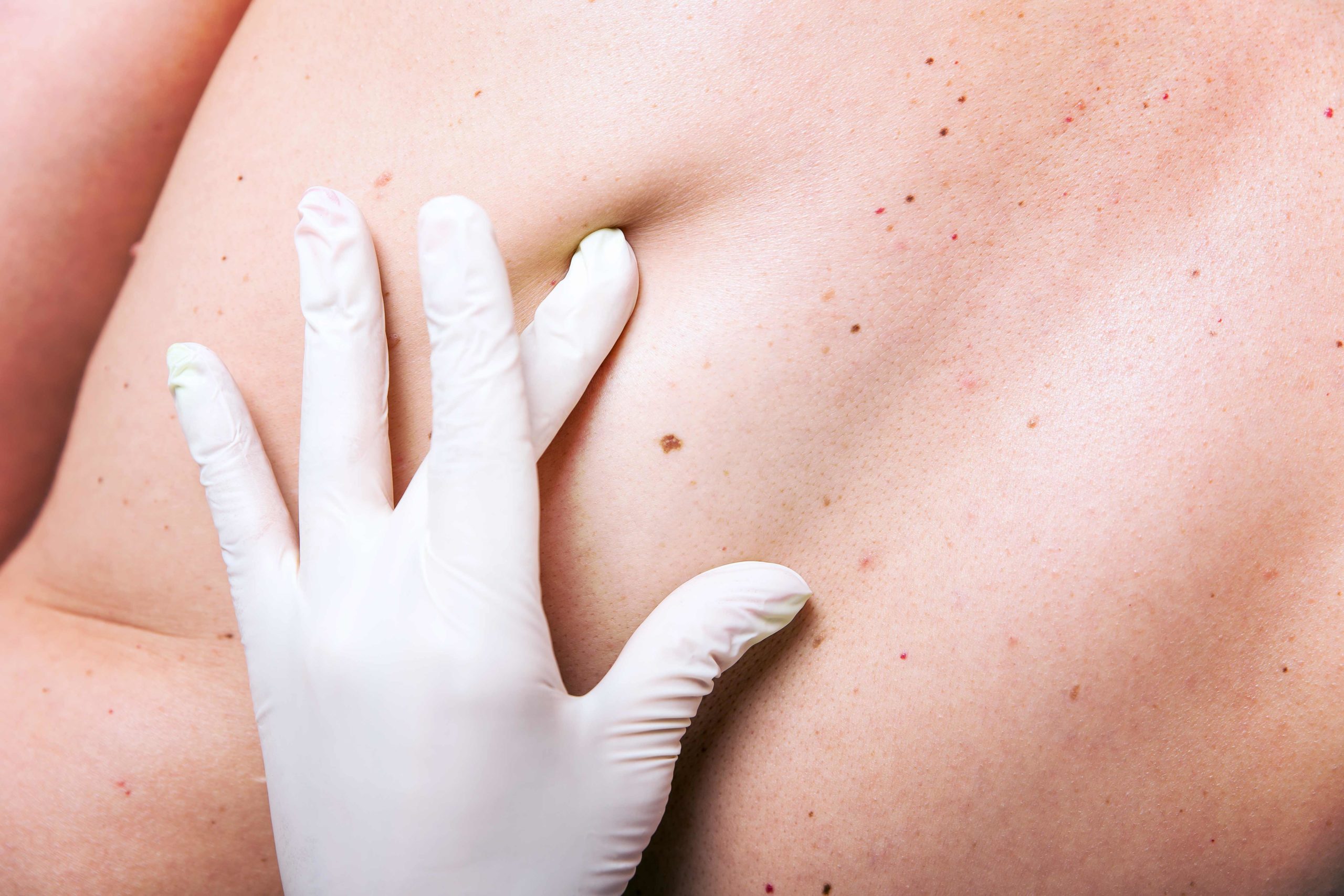 Hautkrebs Vorsorgeuntersuchung und Früherkennung